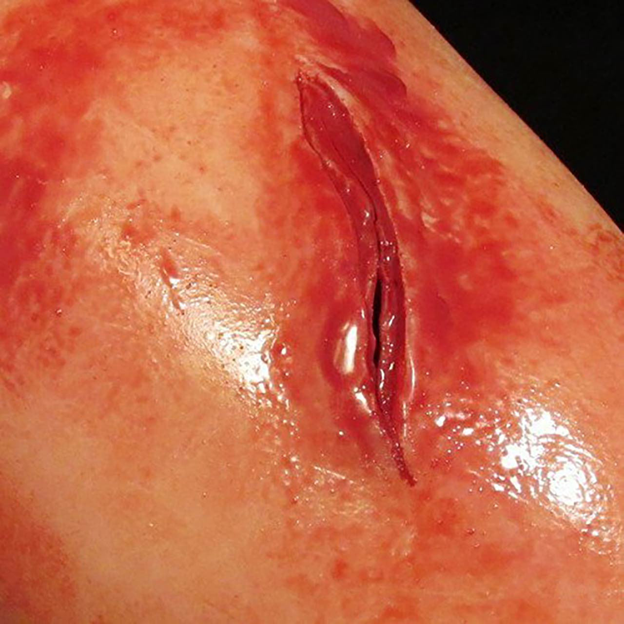 TrueClot® Wound Packing Training Kit close up of knife wound